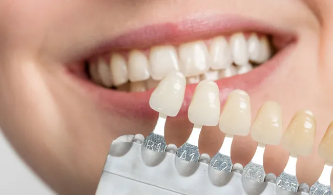طرح توجیهی تولید کامپوزیت دندانپزشکی (انواع کامپوزیت دندان)