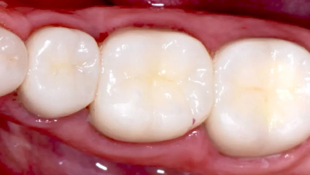 طرح تولید کامپوزیت دندان